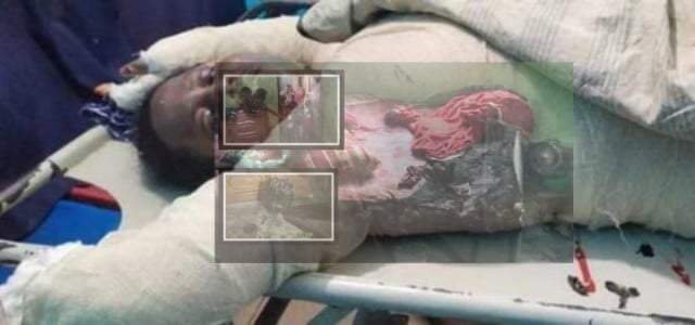 না.গঞ্জে গ্যাসের বিস্ফোরণে দগ্ধ স্বামীর মৃত্যু, স্ত্রী রোজিনা ঝুঁকিপূর্ণ